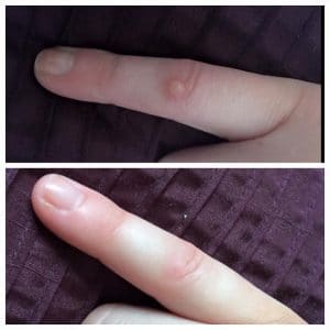 CryoPen wart removal